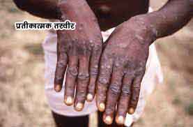 Monkeypox2-1